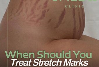 Why Pregnancy Stretch Marks Happen and What You Can Do About Them