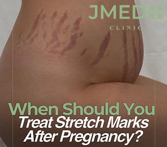 Why Pregnancy Stretch Marks Happen and What You Can Do About Them