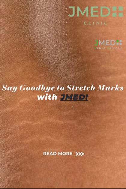 remove my stretch marks permanently remove my stretch marks permanently