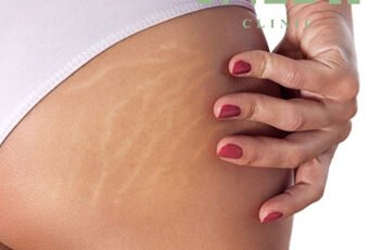 Can Stretch Marks Be Removed Without Surgery