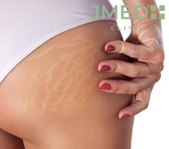 Can Stretch Marks Be Removed Without Surgery