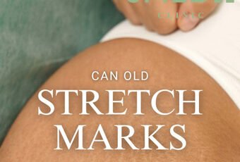 How much does it cost to get rid of stretch marks