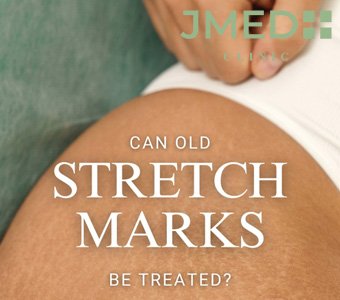 How much does it cost to get rid of stretch marks