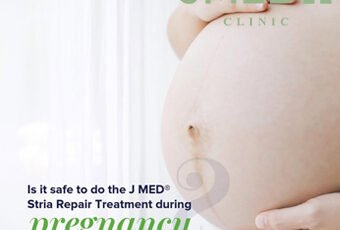 How to treat fresh stretch marks during pregnancy in Dubai