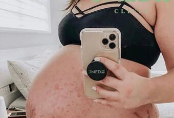 How to treat stretch marks during pregnancy