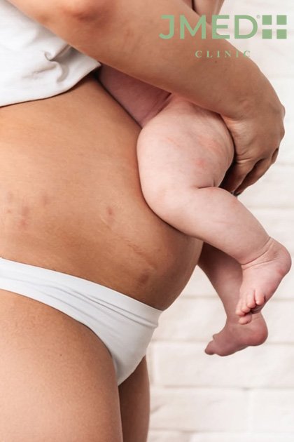 Managing New Stretch Marks During Pregnancy