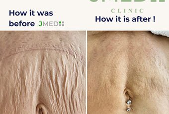 Stretch Mark Recovery Expert Treatments for Postpartum Skin