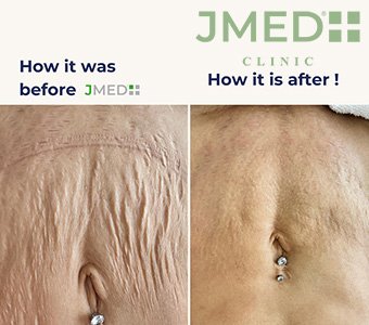 Stretch Mark Recovery Expert Treatments for Postpartum Skin