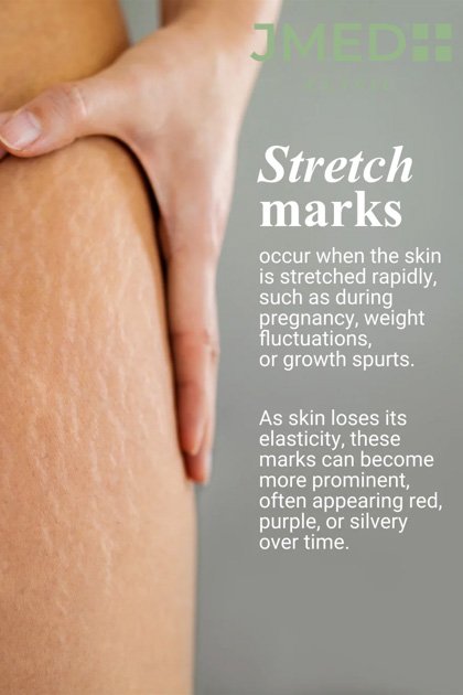 Get rid of stretch marks