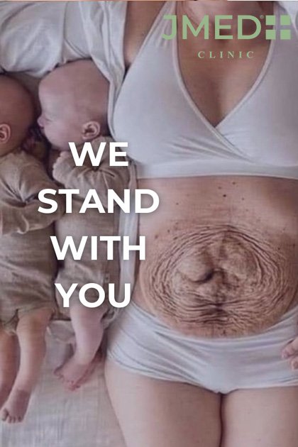 treat stretch marks during pregnancy