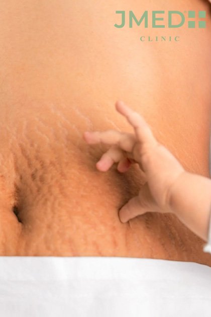without surgery stretch marks removal