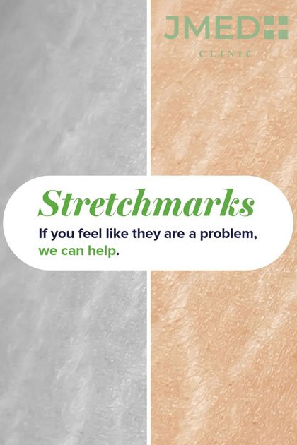 100% Stretch Marks removal in Dubai
