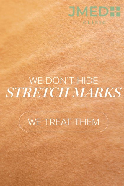 Get Rid of Stretch Marks