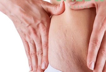 How to Get Rid of Stomach Stretch Marks