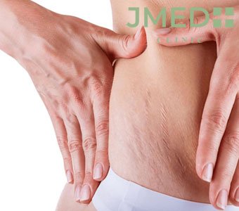 How to Get Rid of Stomach Stretch Marks