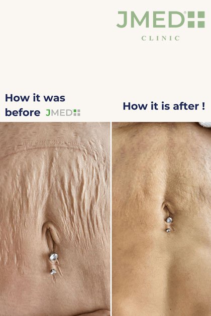 Stretch Marks If I’m Skinny Stretch Marks If I’m Skinny