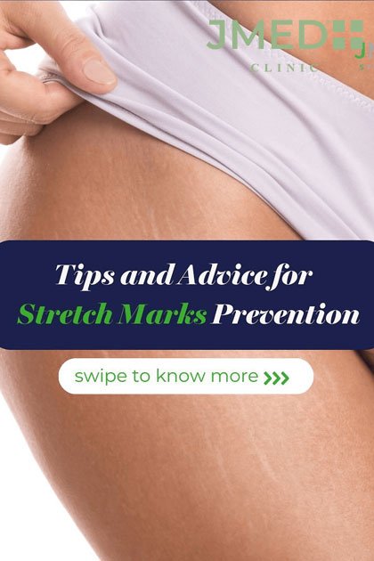 Stretch Marks Treatment in Dubai