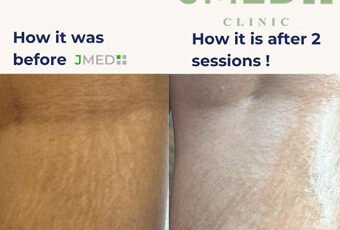 Why Do I Have Stretch Marks If I’m Skinny