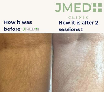 Why Do I Have Stretch Marks If I’m Skinny