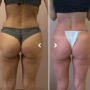 body contouring in Dubai