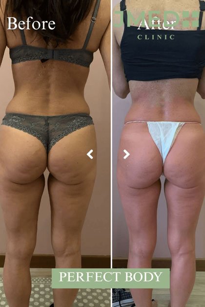 body contouring in Dubai