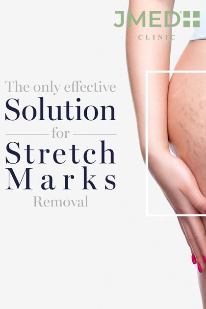 stretch marks treatment Dubai
