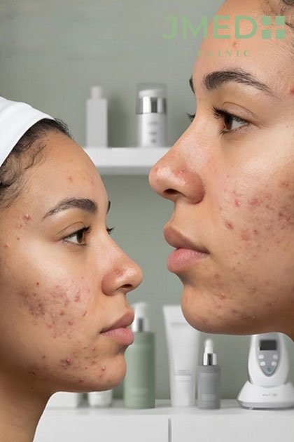 How Stretch Mark Removal Works