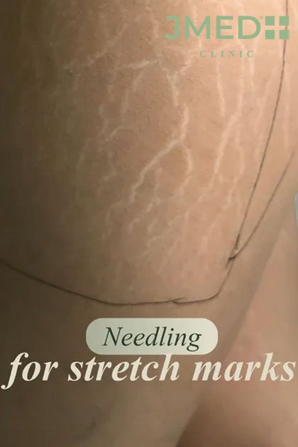 Italian-Inspired Stretch Marks Treatment