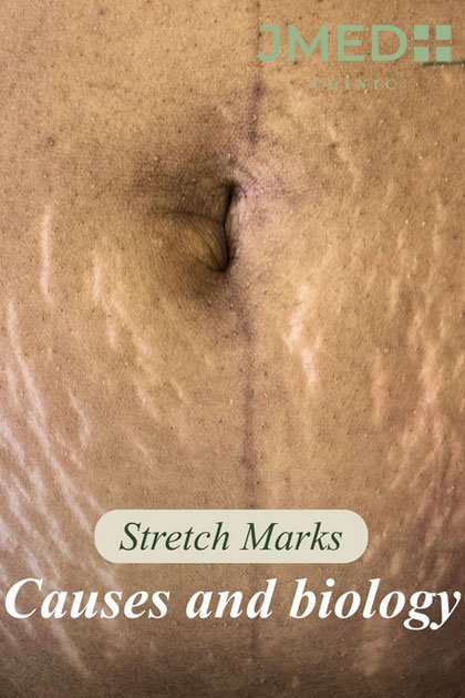 World's No.1 Stretch Marks Removal Specialist