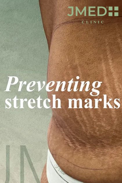 Stretch Marks