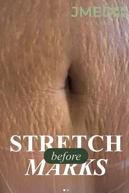 Stretch Marks Removal Africans Skin